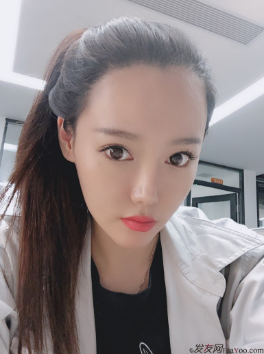 北京南加發(fā)際線調(diào)整案例種植頭發(fā)成功案例