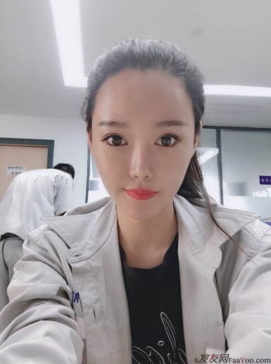 北京南加發(fā)際線調(diào)整案例種植頭發(fā)成功案例