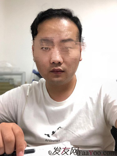 二次植發(fā)，發(fā)現不一樣的自己，植發(fā)記錄貼