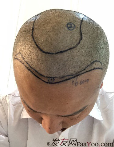 二次植發(fā)，發(fā)現不一樣的自己，植發(fā)記錄貼