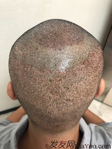 二次植發(fā)，發(fā)現不一樣的自己，植發(fā)記錄貼