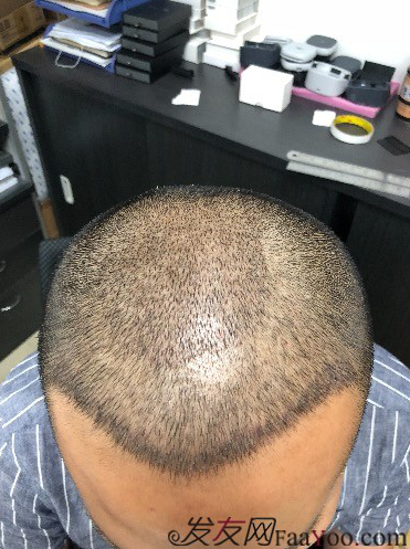 二次植發(fā)，發(fā)現不一樣的自己，植發(fā)記錄貼