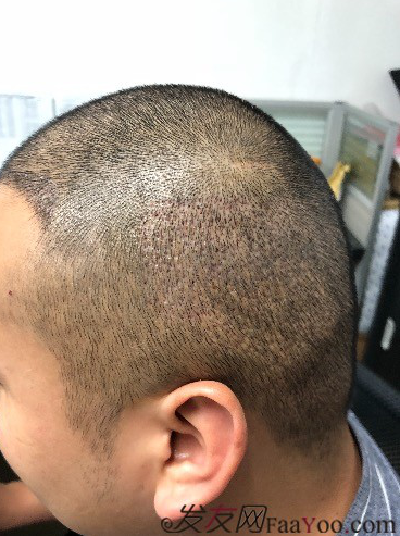 二次植發(fā)，發(fā)現不一樣的自己，植發(fā)記錄貼