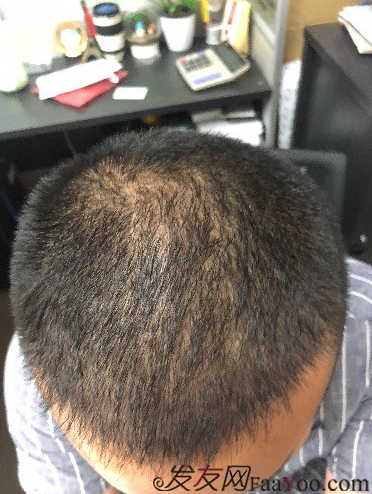 二次植發(fā)，發(fā)現不一樣的自己，植發(fā)記錄貼