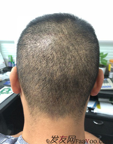 二次植發(fā)，發(fā)現不一樣的自己，植發(fā)記錄貼