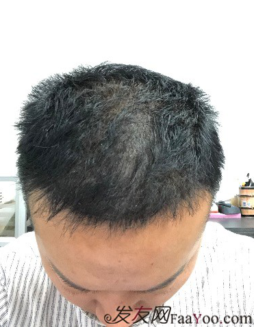 二次植發(fā)，發(fā)現不一樣的自己，植發(fā)記錄貼