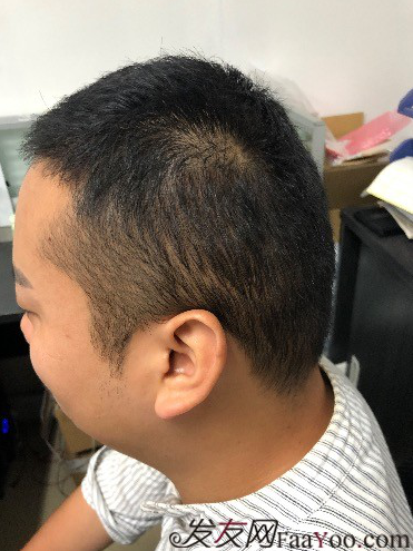 二次植發(fā)，發(fā)現不一樣的自己，植發(fā)記錄貼