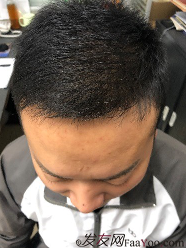 二次植發(fā)，發(fā)現不一樣的自己，植發(fā)記錄貼