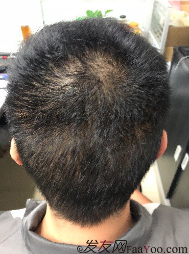 二次植發(fā)，發(fā)現不一樣的自己，植發(fā)記錄貼