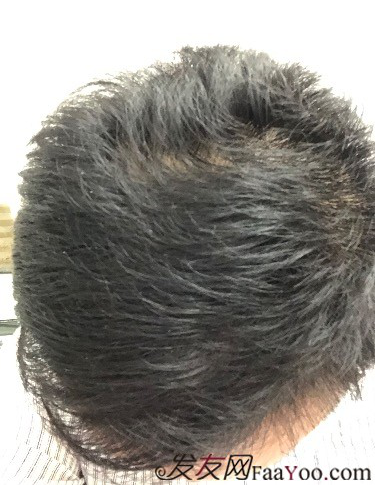 二次植發(fā)，發(fā)現不一樣的自己，植發(fā)記錄貼