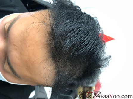 二次植發(fā)，發(fā)現不一樣的自己，植發(fā)記錄貼