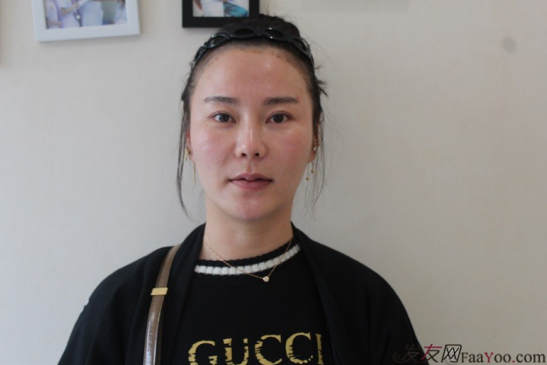 北京南加發(fā)際線種植，銀盆大臉終于修煉成了鄰家幼幼