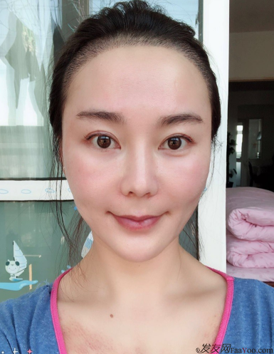 北京南加發(fā)際線種植，銀盆大臉終于修煉成了鄰家幼幼