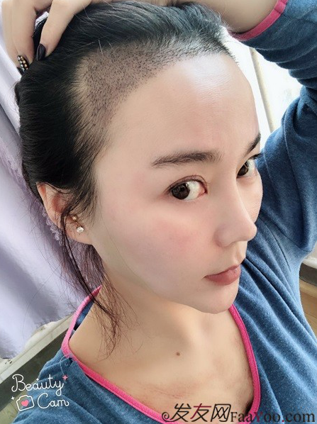 北京南加發(fā)際線種植，銀盆大臉終于修煉成了鄰家幼幼