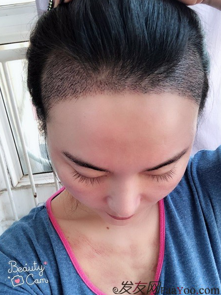 北京南加發(fā)際線種植，銀盆大臉終于修煉成了鄰家幼幼