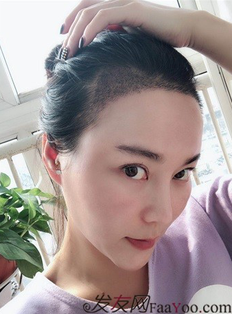 北京南加發(fā)際線種植，銀盆大臉終于修煉成了鄰家幼幼