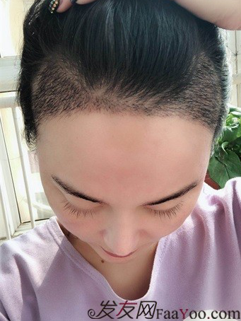 北京南加發(fā)際線種植，銀盆大臉終于修煉成了鄰家幼幼