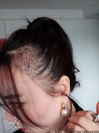 北京南加發(fā)際線種植，銀盆大臉終于修煉成了鄰家幼幼