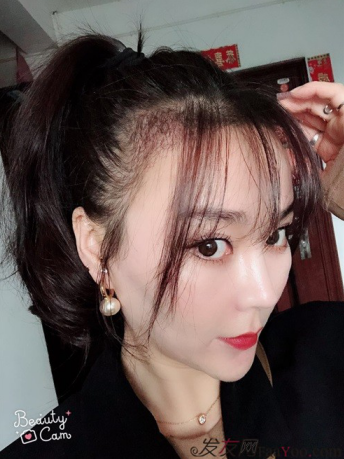 北京南加發(fā)際線種植，銀盆大臉終于修煉成了鄰家幼幼