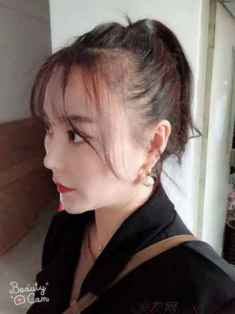 北京南加發(fā)際線種植，銀盆大臉終于修煉成了鄰家幼幼