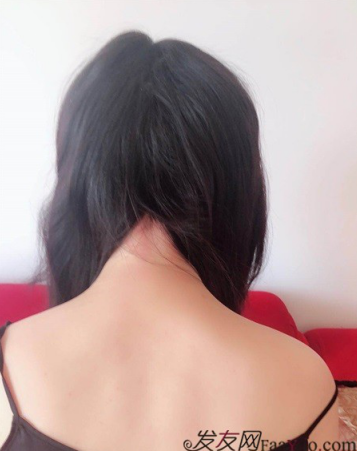 北京南加發(fā)際線種植，銀盆大臉終于修煉成了鄰家幼幼