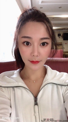 北京南加發(fā)際線種植，銀盆大臉終于修煉成了鄰家幼幼