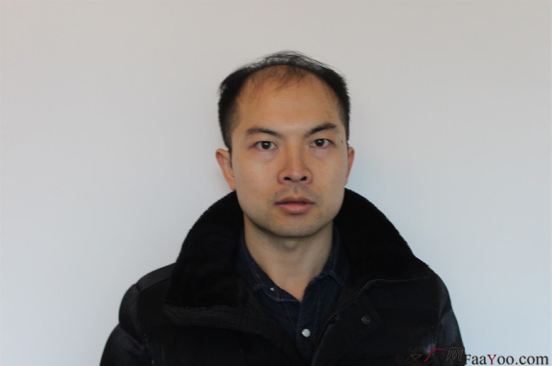 北京大面積植發(fā)4000單位一年恢復(fù)全程記錄