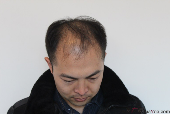 北京大面積植發(fā)4000單位一年恢復(fù)全程記錄