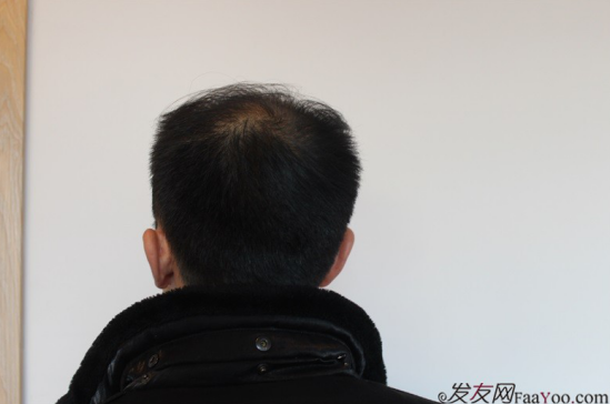 北京大面積植發(fā)4000單位一年恢復(fù)全程記錄