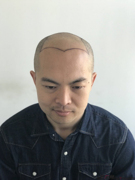 北京大面積植發(fā)4000單位一年恢復(fù)全程記錄