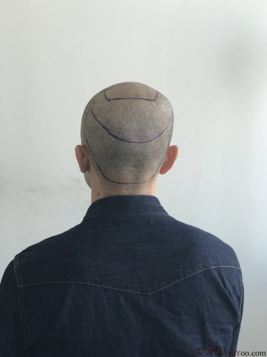 北京大面積植發(fā)4000單位一年恢復(fù)全程記錄