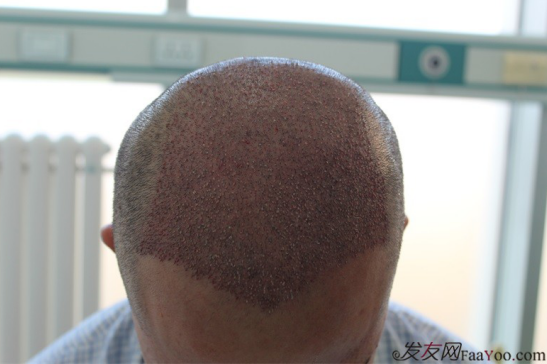 北京大面積植發(fā)4000單位一年恢復(fù)全程記錄