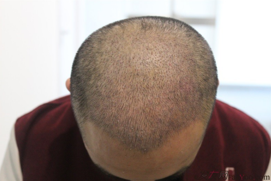 北京大面積植發(fā)4000單位一年恢復(fù)全程記錄