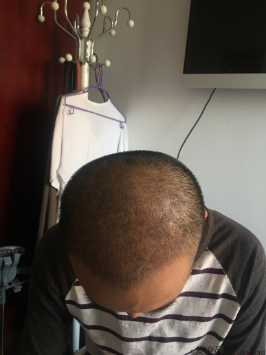 北京大面積植發(fā)4000單位一年恢復(fù)全程記錄