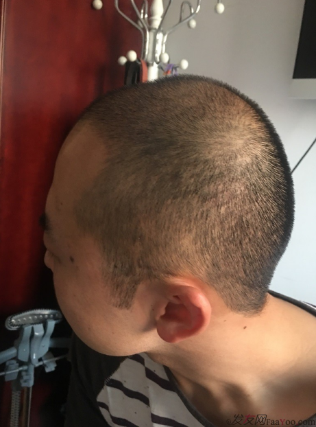 北京大面積植發(fā)4000單位一年恢復(fù)全程記錄