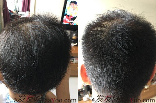 北京大面積植發(fā)4000單位一年恢復(fù)全程記錄