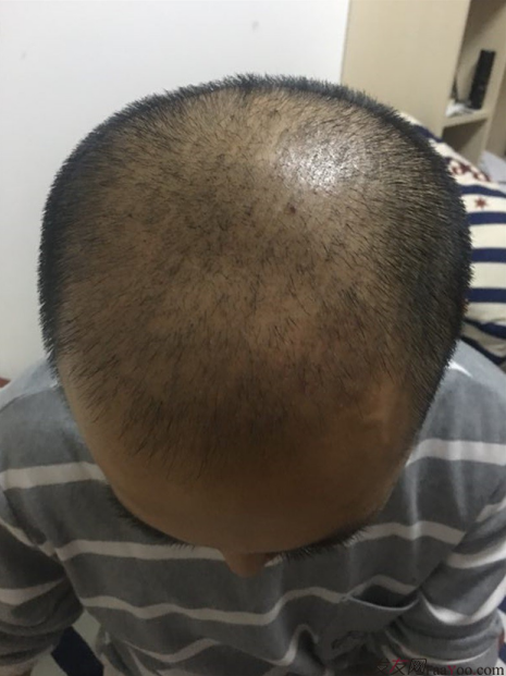 北京大面積植發(fā)4000單位一年恢復(fù)全程記錄