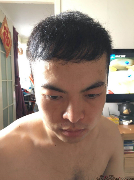 北京大面積植發(fā)4000單位一年恢復(fù)全程記錄