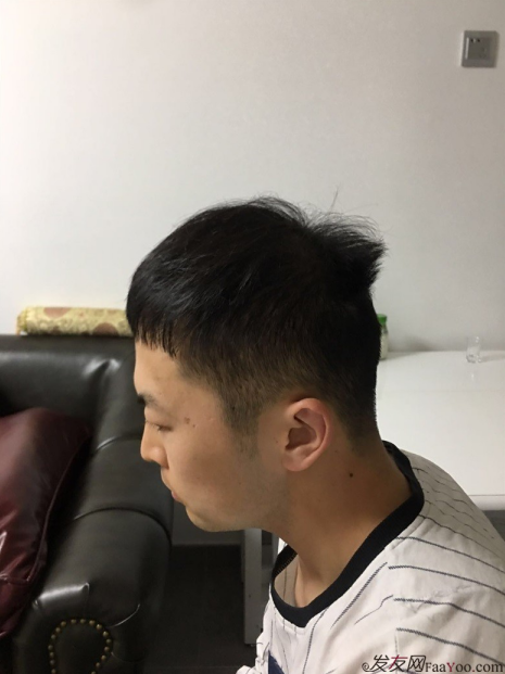 北京大面積植發(fā)4000單位一年恢復(fù)全程記錄