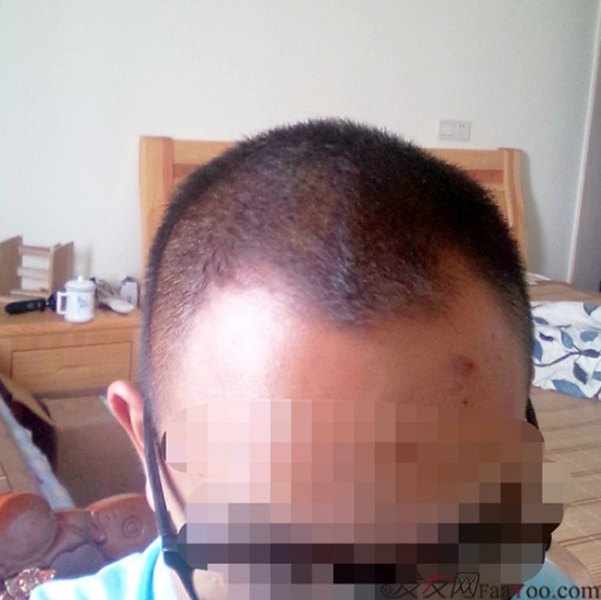 廣州大麥微針1600單位感謝發(fā)友網(wǎng)，記錄一個(gè)真實(shí)