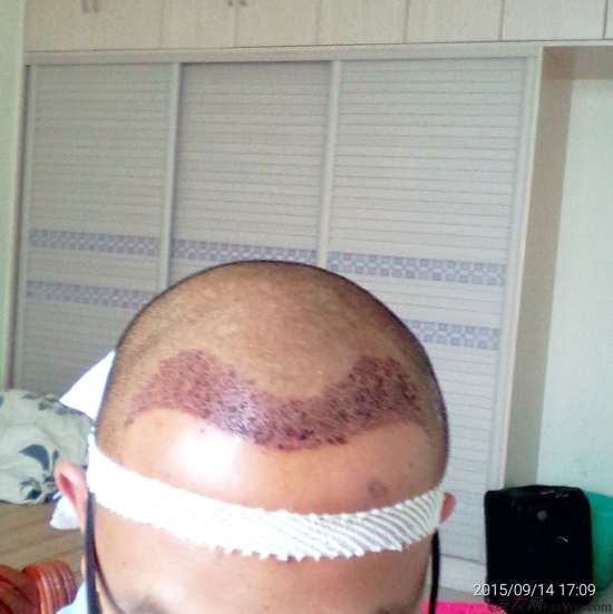 廣州大麥微針1600單位感謝發(fā)友網(wǎng)，記錄一個(gè)真實(shí)