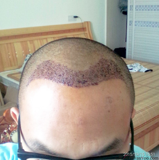 廣州大麥微針1600單位感謝發(fā)友網(wǎng)，記錄一個(gè)真實(shí)