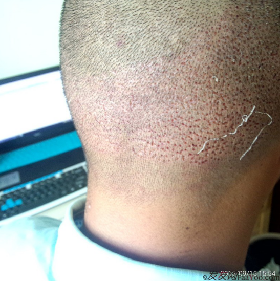 廣州大麥微針1600單位感謝發(fā)友網(wǎng)，記錄一個(gè)真實(shí)