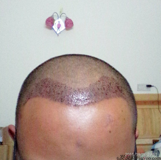 廣州大麥微針1600單位感謝發(fā)友網(wǎng)，記錄一個(gè)真實(shí)