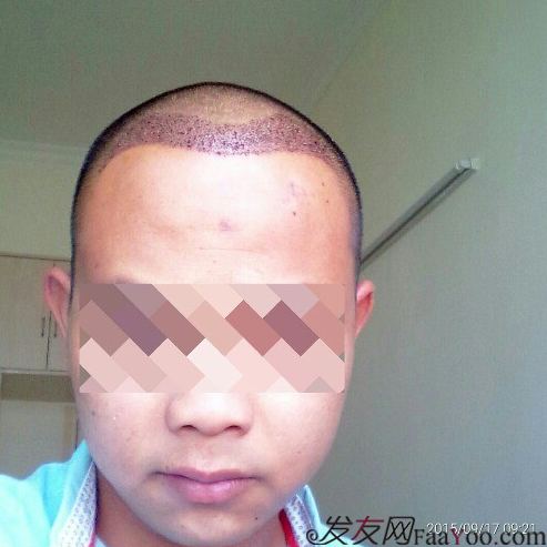 廣州大麥微針1600單位感謝發(fā)友網(wǎng)，記錄一個(gè)真實(shí)