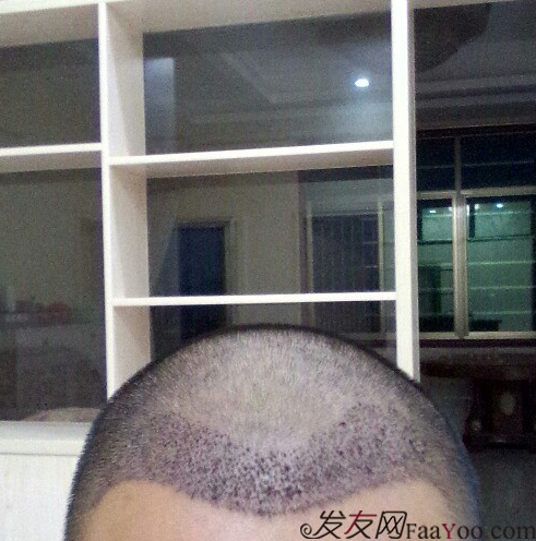 廣州大麥微針1600單位感謝發(fā)友網(wǎng)，記錄一個(gè)真實(shí)