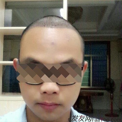 廣州大麥微針1600單位感謝發(fā)友網(wǎng)，記錄一個(gè)真實(shí)