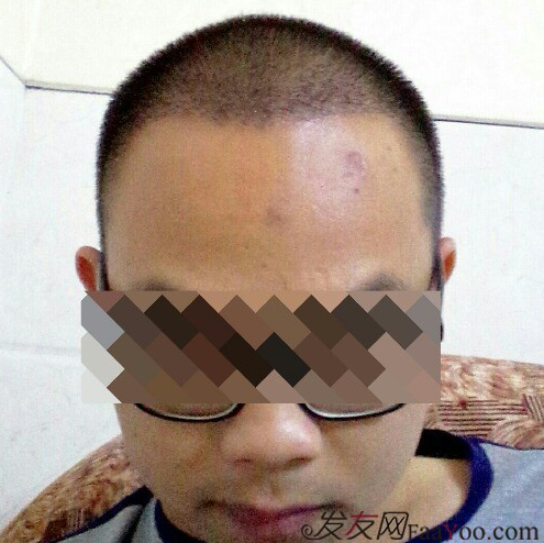 廣州大麥微針1600單位感謝發(fā)友網(wǎng)，記錄一個(gè)真實(shí)