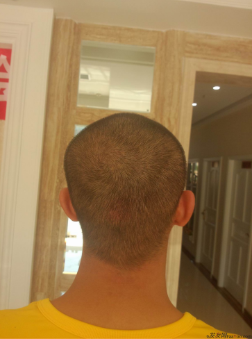 西安大麥微針植發(fā)案例，繼續(xù)看我逆襲蛻變