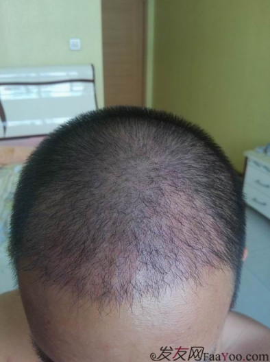 西安大麥微針植發(fā)案例，繼續(xù)看我逆襲蛻變